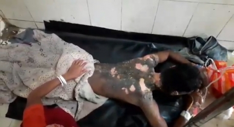 বন্ধুর ছোঁড়া পেট্রোলে ঝলসে গেলো সুবল রায়ের শরীর