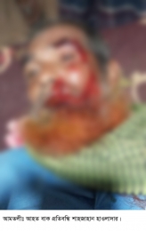 বাক প্রতিবন্ধিকে ইট দিয়ে পিটিয়ে মুখমন্ডল থেতলে দিয়েছে সন্ত্রাসীরা।