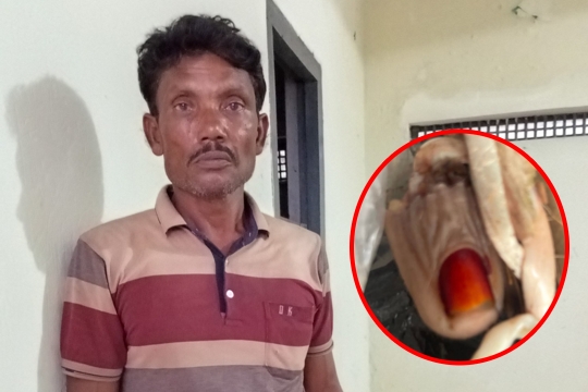 ​চৌগাছা নারীর আঙুল কামড়ে ছিঁড়ে ফেলল এক লম্পট, আটক ১