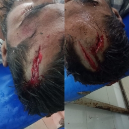 ঝালকাঠির রাজাপুরে পৈতৃক সম্পত্তির বিরোধে মামাতো ভাই কর্তৃক ফুফাতো ভাইকে এলোপাতাড়ি কুপিয়ে জখম