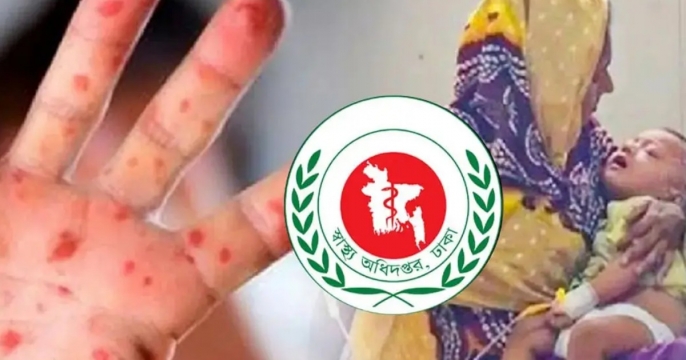 হামের উপসর্গে আরও ৩ শিশুর মৃত্যু