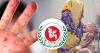 হামের উপসর্গ নিয়ে আরও ৫ জনের মৃত্যু, বাড়ছে উদ্বেগ
