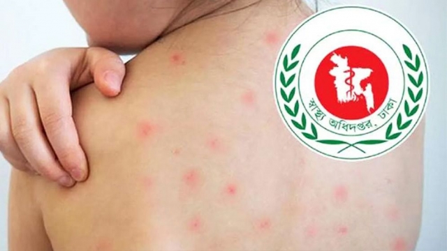 হাম উপসর্গে আরও ৪ শিশুর মৃত্যু